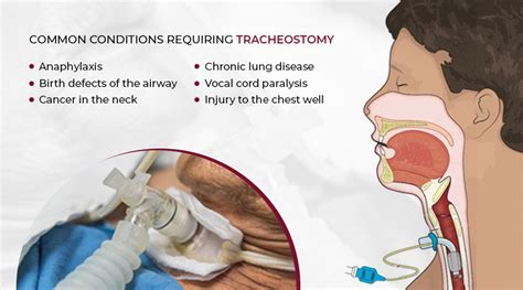 trake in throat|why do a tracheostomy.